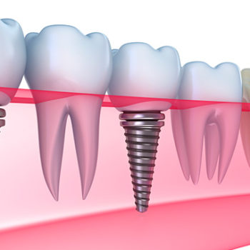 Имплантация зубов в «Жемчужина Стом»