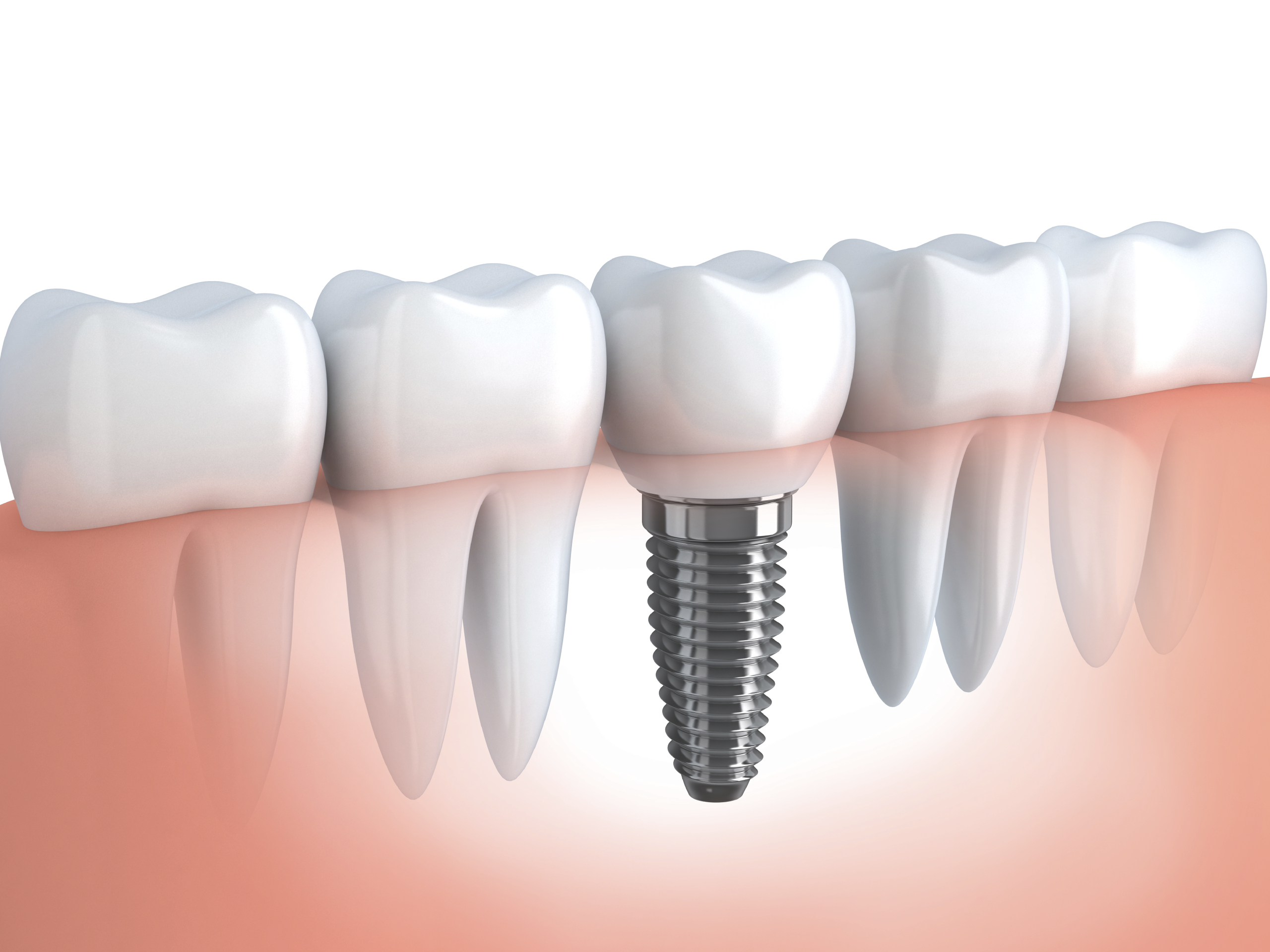 Имплантация зубов в «Жемчужина Стом»